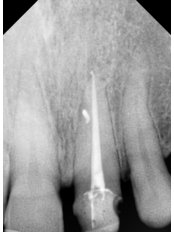 Complex Root Canal - Dr Madhu's Dental Care