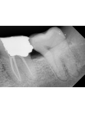 Endodontist Consultation - Dr Madhu's Dental Care