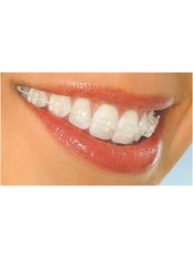Braces - International Dental Clinic Cochin