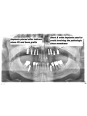 Dental Implants - International Dental Clinic Cochin