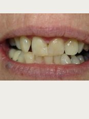 Kirans Dental Clinic-Vypeen - Pt with irregular discoloured teeth