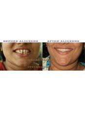 CLEARBITE ORTHODONTIC ALIGNERS - Nechupadam Dental Clinic