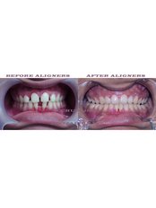 CLEARBITE ORTHODONTIC ALIGNERS - Nechupadam Dental Clinic