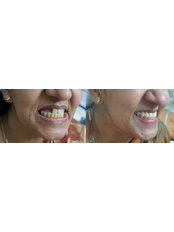 Dental Bridges - Nechupadam Dental Clinic