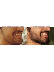 CLEARPATH ORTHODONTIC ALIGNERS - Nechupadam Dental Clinic