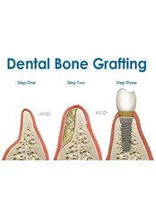 Bone Graft  - Tours2health Dental Services