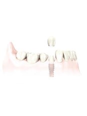 Single Implant - Aesthetica - Specialty Dental Clinic