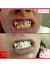 Teeth Cleaning - Amazing Smiles