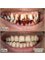Amazing Smiles - Teeth Scaling and Polishing ( Tobacco Stain Removal) 