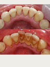 Medicure Polyclinic - Scaling Before & After