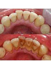 Medicure Polyclinic - Scaling Before & After 