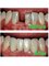 Medicure Polyclinic - Restoration of Missing Teeth 