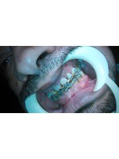 before treatment - Dr.Amith Dental Implant and Tooth Care Center