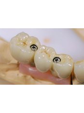 Implant Bridge - Rama Dental Clinic