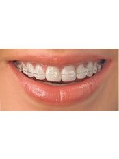 Clear Braces - Agaram Dental Clinic