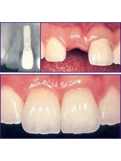 Dental Implants - Agaram Dental Clinic