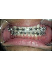 Metal Braces - Agaram Dental Clinic