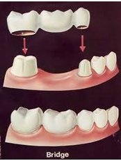 Fixed Partial Dentures - Agaram Dental Clinic