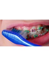 Child Braces - Agaram Dental Clinic