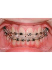 Fixed Braces - Agaram Dental Clinic