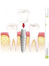 Immediate teeth after implant surgery - Dr Hubert Gomes Dental Clinic