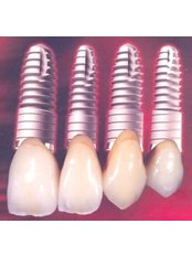 Dental implants - Dr Hubert Gomes Dental Clinic