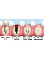 Bone Graft - Dr Richa's Cosmodent Cosmetics & Dental Clinic
