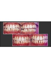Gum Surgery - Impressions dental and maxillofacial center