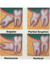Extractions - Impressions dental and maxillofacial center