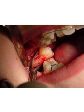 Extractions - Impressions dental and maxillofacial center