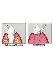 Gingivitis Treatment - Impressions dental and maxillofacial center