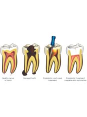 Endodontist Consultation - Impressions dental and maxillofacial center