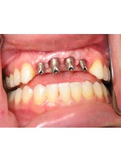 Implant Dentist Consultation - Impressions dental and maxillofacial center
