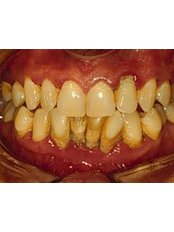 Gingivitis Treatment - Impressions dental and maxillofacial center