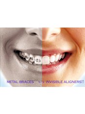 Braces - Almas Dental Clinic