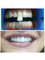 Cosmecare Dentistry - Zoom Bleaching[ Teeth Whitening ] 