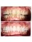 Cosmecare Dentistry - Zoom Bleaching [ Teeth Whitening] 