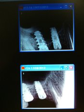 Bone Graft  - Cosmodent Implant Clinic