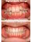 Dental Care - Smile Correction using Veneers & Orthodontics 