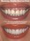 Dental Care - Gummy Smile Correction using lasers & Veneers 
