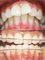 Dental Care - Braces / Orthodontic Treatment Before & After 
