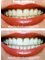 Dental Care - Laser Teeth Whitening 