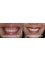 Dental Care - Gummy Smile Correction doing, Laser Frenectomy, Crown Lenghtening, Lip Repostioning 