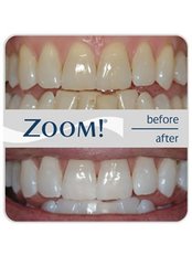 Zoom! Teeth Whitening - Dentissimo Dental Care  Spa