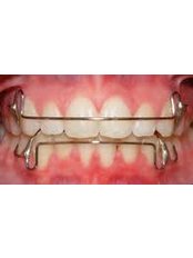 Orthodontic Retainer - Dr Sejpals Smile XL Clinic
