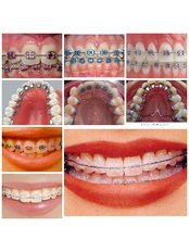 Braces - Dr Sejpals Smile XL Clinic