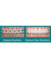 Damon™ Braces - Dr Sejpals Smile XL Clinic