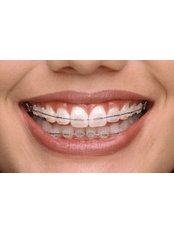 Ceramic Braces - Dr Sejpals Smile XL Clinic