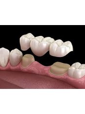 Dental Bridges - dr.richa's dental serinity miraroad mumbai