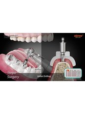 Implant Bridge - dr.richa's dental serinity miraroad mumbai
